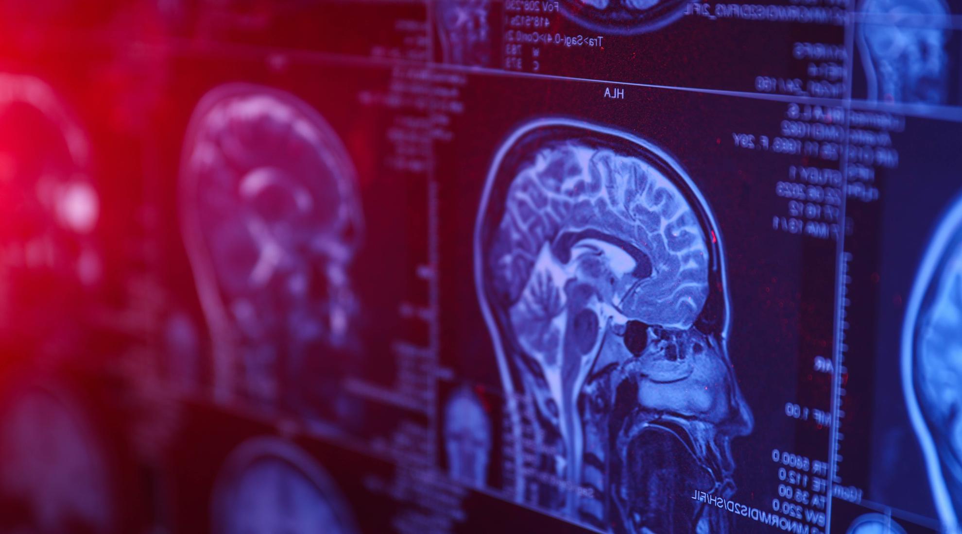 Scan of a brain