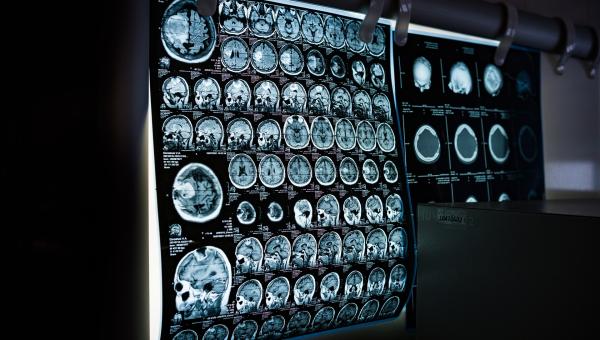 MRI scanning