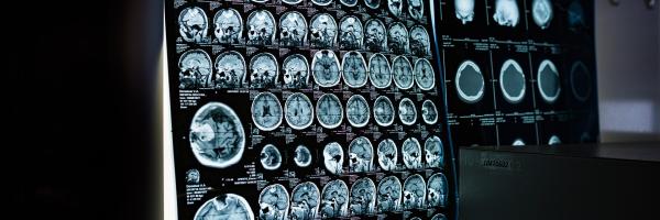 MRI scanning